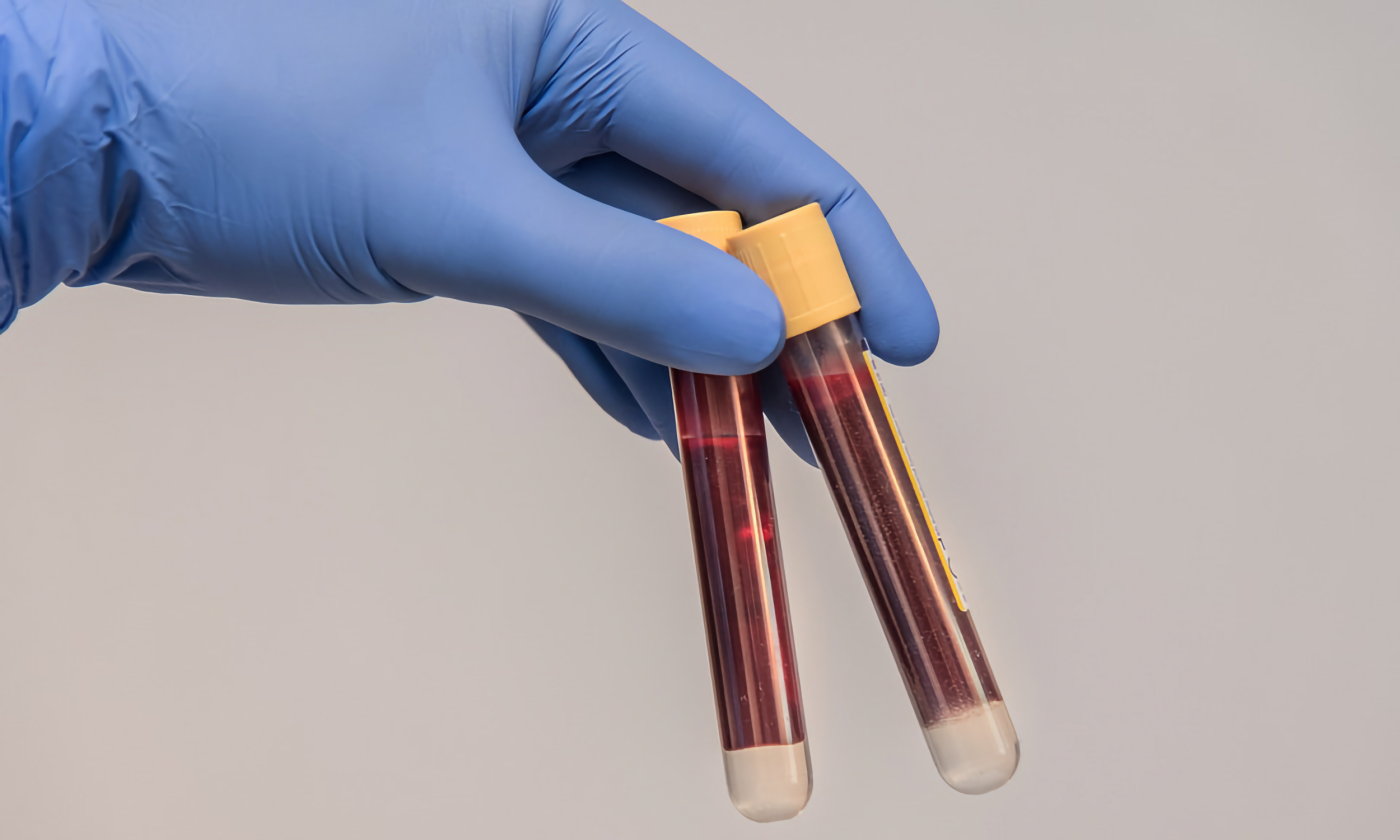 A full color image of a gloved hand holding two yellow-lidded vials of blood.
